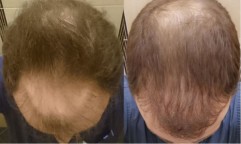 Przeszczep włosów metodą FUE. Pacjent Consensus med przed zabiegiem i 12 miesięcy po zabiegu.