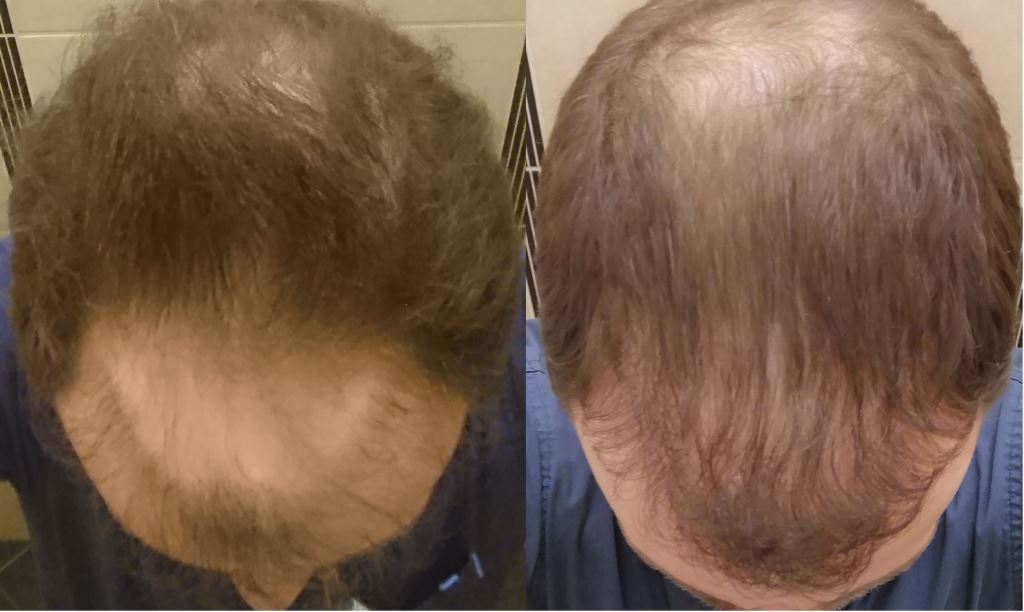 przeszczep włosów, przeszczep włosów metodą FUE, leczenie wypadania włosów